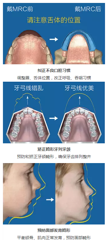 儿牙专栏 mrc矫正| 矫正牙齿要等到12岁?你out了