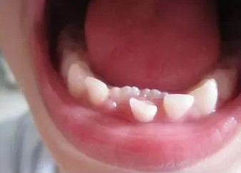 如果超过这段时间宝贝的乳牙还没有松动脱落的现象,那家长们就要小心