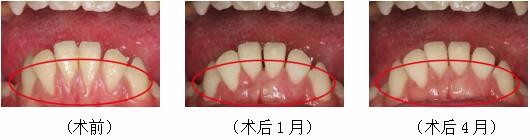 新闻|昆山首例牙周膜龈手术在我院顺利完成啦!