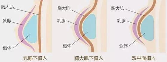 假体植入层次
