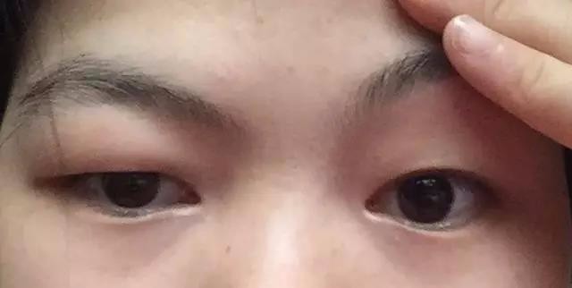 去昆山铂特丽割双眼皮,告别这睡不醒的小眼睛