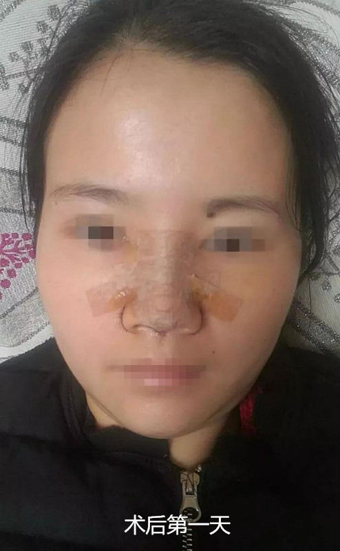鼻梁高了,鼻尖长了,鼻子精致多了