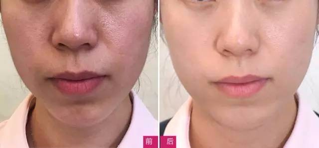 昆山铂特丽医美——水光针坚持打,年轻10岁不是梦!