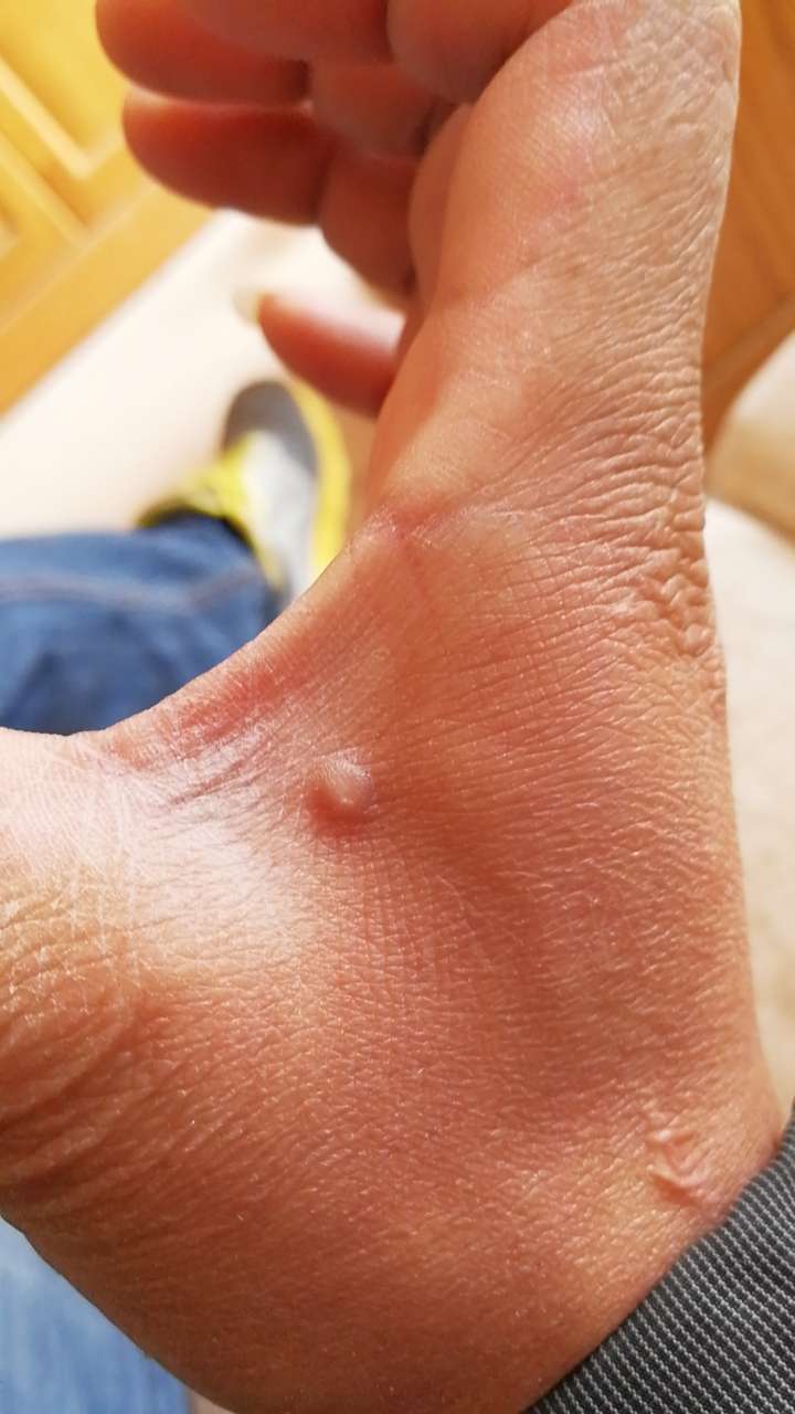 家里娃手上长了这样的小疙瘩长得还挺快的